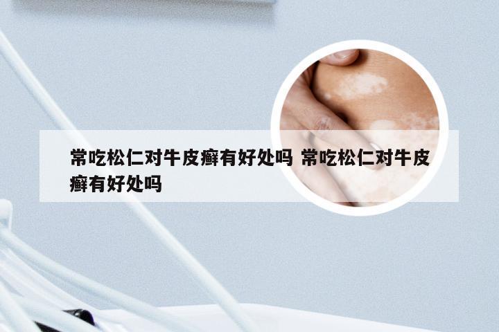 常吃松仁对牛皮癣有好处吗 常吃松仁对牛皮癣有好处吗
