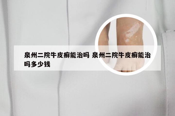 泉州二院牛皮癣能治吗 泉州二院牛皮癣能治吗多少钱