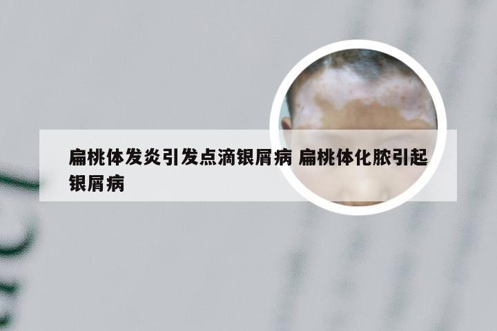 扁桃体发炎引发点滴银屑病 扁桃体化脓引起银屑病