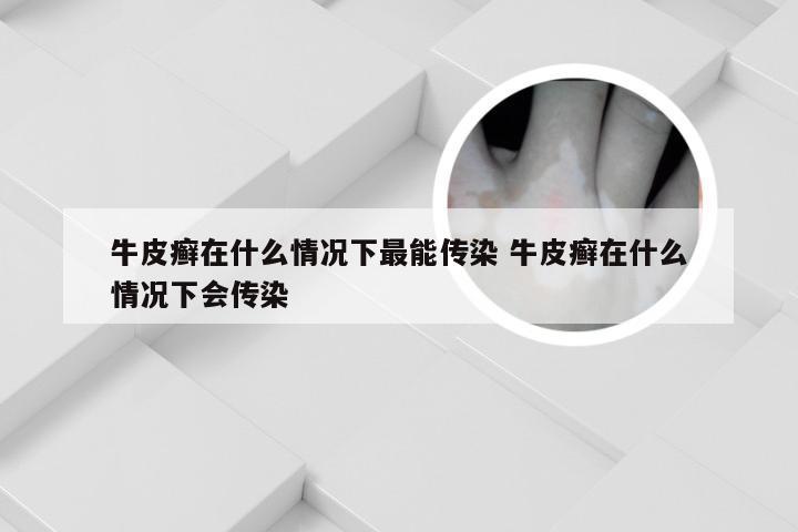 牛皮癣在什么情况下最能传染 牛皮癣在什么情况下会传染