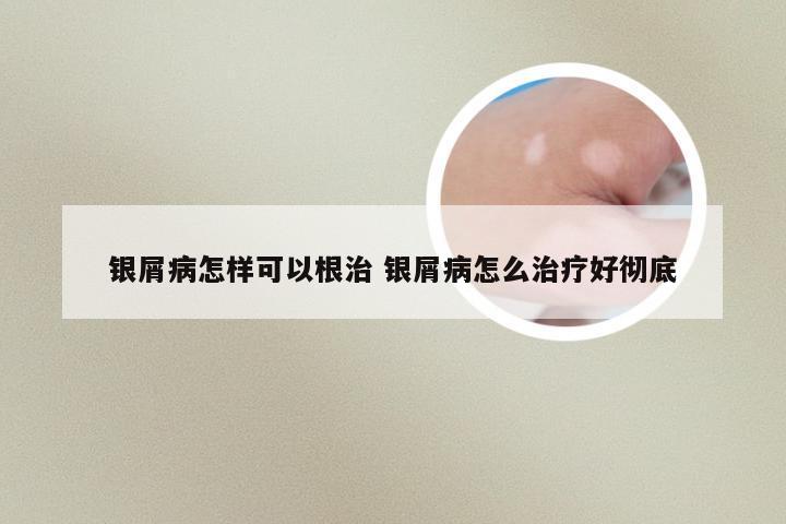 银屑病怎样可以根治 银屑病怎么治疗好彻底