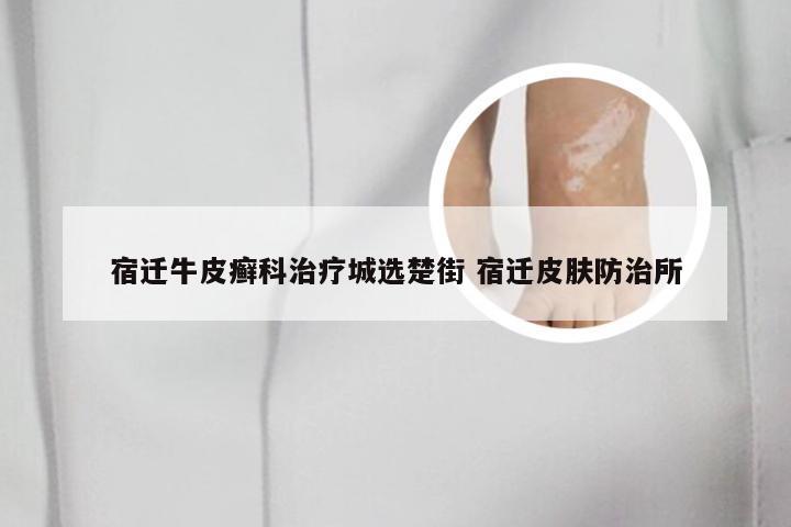 宿迁牛皮癣科治疗城选楚街 宿迁皮肤防治所