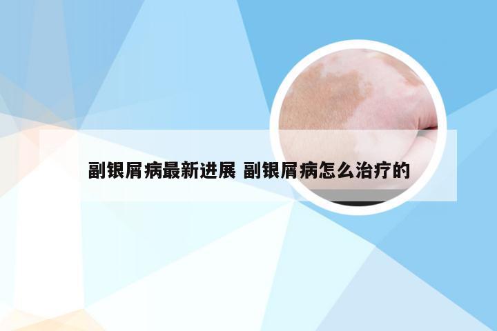 副银屑病最新进展 副银屑病怎么治疗的