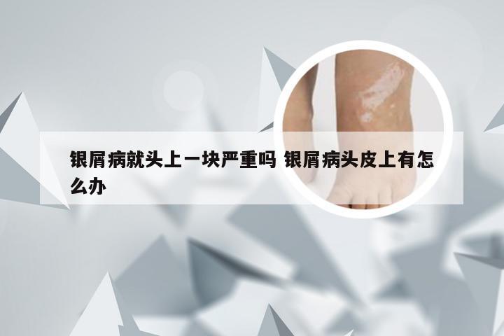 银屑病就头上一块严重吗 银屑病头皮上有怎么办
