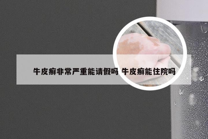 牛皮癣非常严重能请假吗 牛皮癣能住院吗