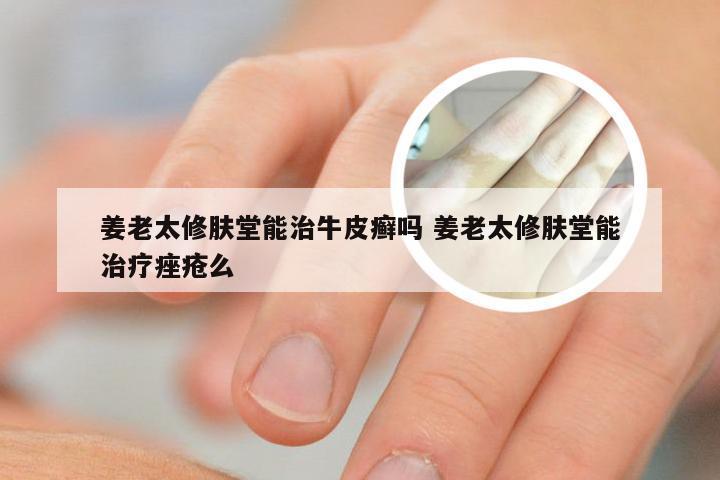 姜老太修肤堂能治牛皮癣吗 姜老太修肤堂能治疗痤疮么