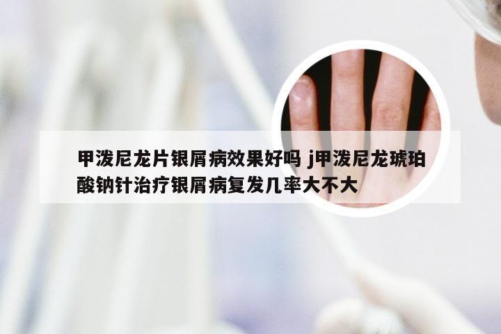 甲泼尼龙片银屑病效果好吗 j甲泼尼龙琥珀酸钠针治疗银屑病复发几率大不大