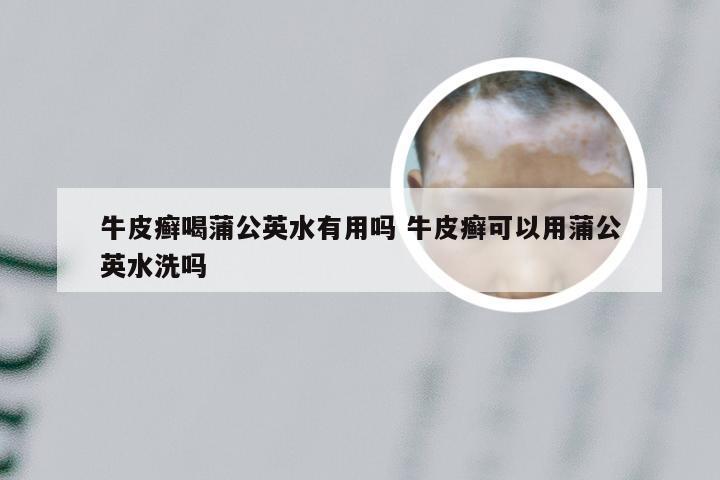 牛皮癣喝蒲公英水有用吗 牛皮癣可以用蒲公英水洗吗