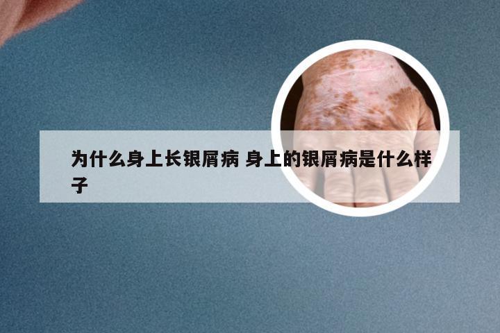 为什么身上长银屑病 身上的银屑病是什么样子