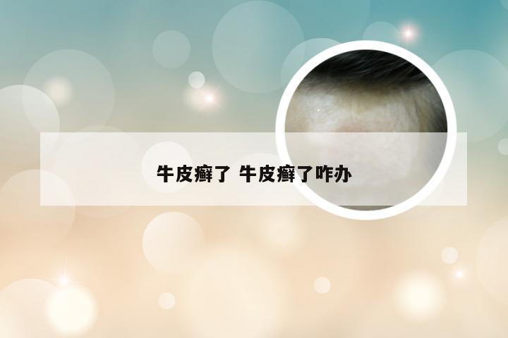 牛皮癣了 牛皮癣了咋办