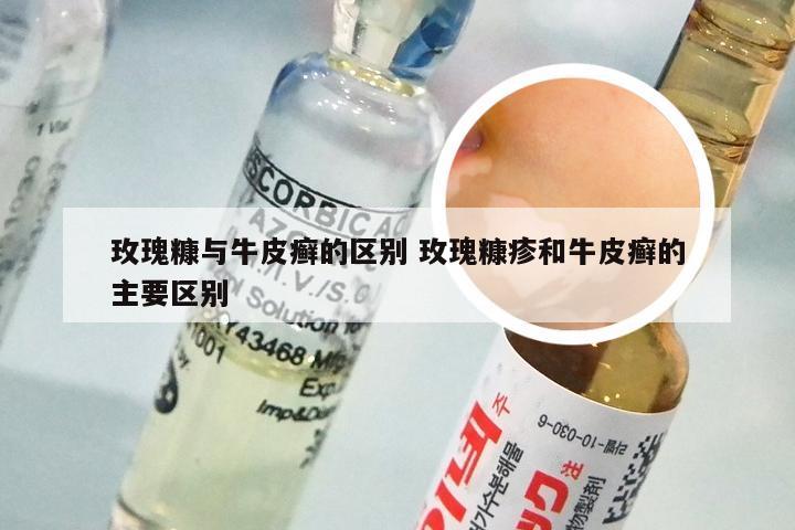玫瑰糠与牛皮癣的区别 玫瑰糠疹和牛皮癣的主要区别