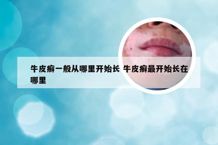 牛皮癣一般从哪里开始长 牛皮癣最开始长在哪里