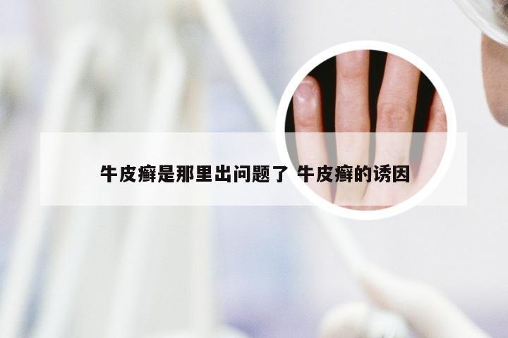 牛皮癣是那里出问题了 牛皮癣的诱因
