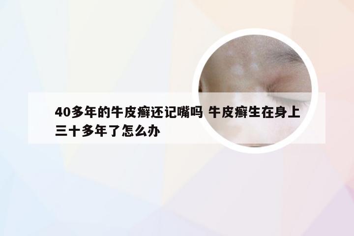 40多年的牛皮癣还记嘴吗 牛皮癣生在身上三十多年了怎么办