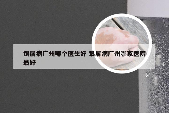银屑病广州哪个医生好 银屑病广州哪家医院最好