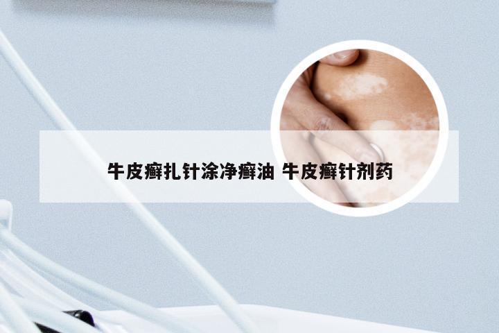 牛皮癣扎针涂净癣油 牛皮癣针剂药