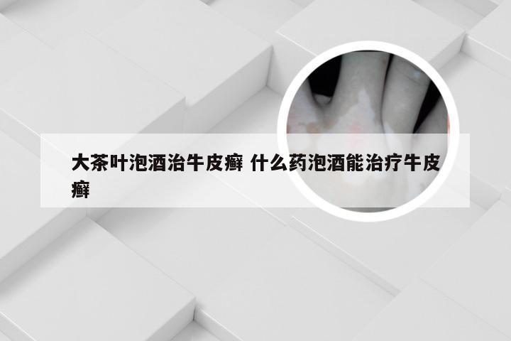 大茶叶泡酒治牛皮癣 什么药泡酒能治疗牛皮癣