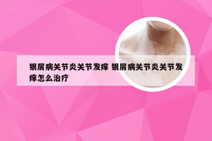 银屑病关节炎关节发痒 银屑病关节炎关节发痒怎么治疗