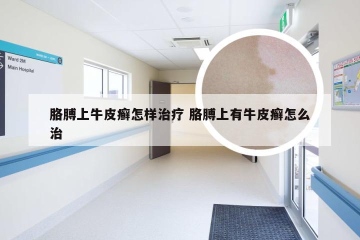 胳膊上牛皮癣怎样治疗 胳膊上有牛皮癣怎么治
