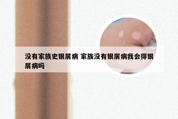 没有家族史银屑病 家族没有银屑病我会得银屑病吗