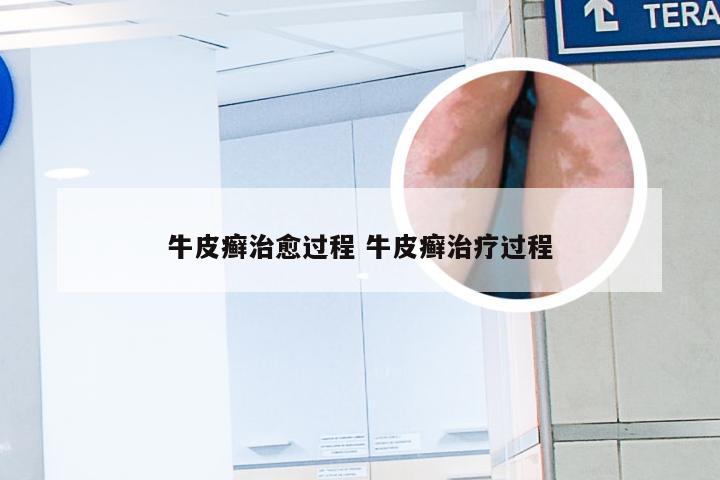 牛皮癣治愈过程 牛皮癣治疗过程