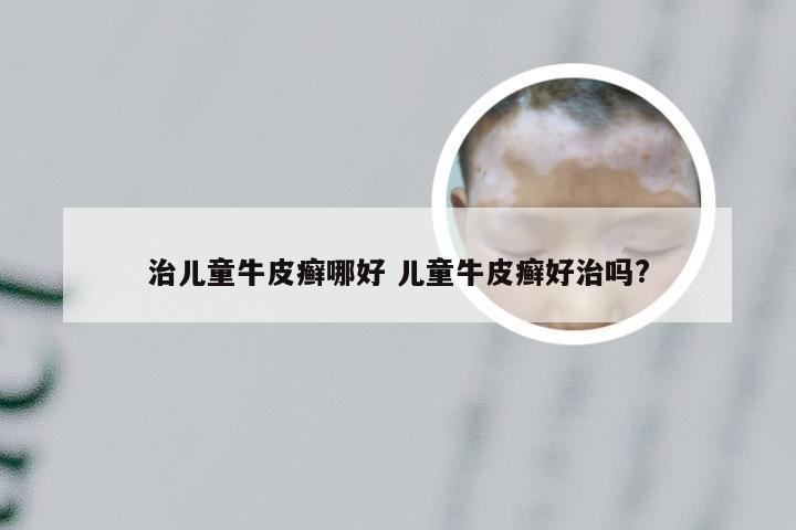 治儿童牛皮癣哪好 儿童牛皮癣好治吗?