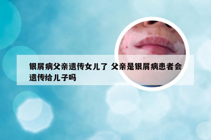 银屑病父亲遗传女儿了 父亲是银屑病患者会遗传给儿子吗