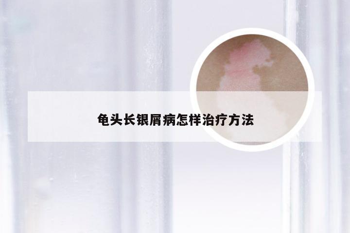 龟头长银屑病怎样治疗方法