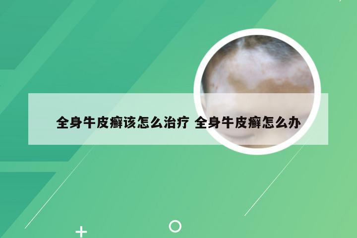 全身牛皮癣该怎么治疗 全身牛皮癣怎么办