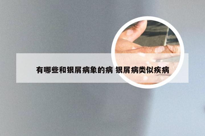 有哪些和银屑病象的病 银屑病类似疾病