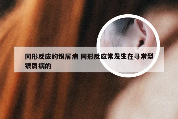 同形反应的银屑病 同形反应常发生在寻常型银屑病的