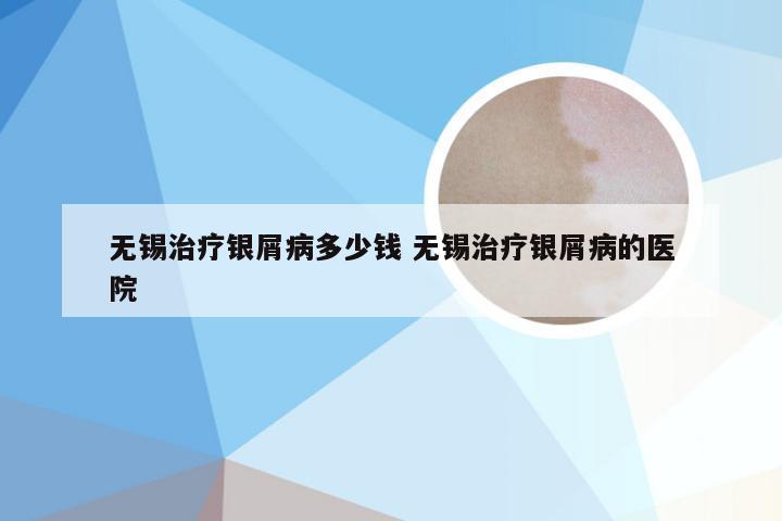 无锡治疗银屑病多少钱 无锡治疗银屑病的医院