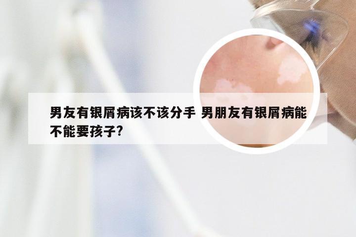 男友有银屑病该不该分手 男朋友有银屑病能不能要孩子?