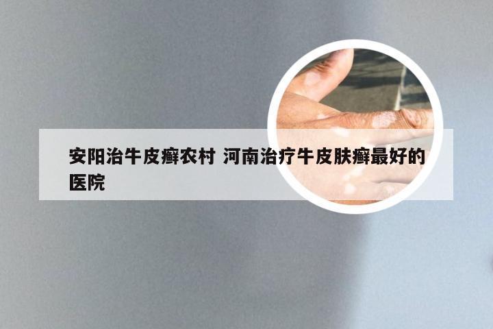 安阳治牛皮癣农村 河南治疗牛皮肤癣最好的医院