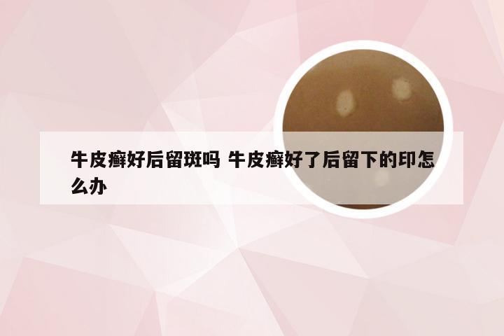 牛皮癣好后留斑吗 牛皮癣好了后留下的印怎么办