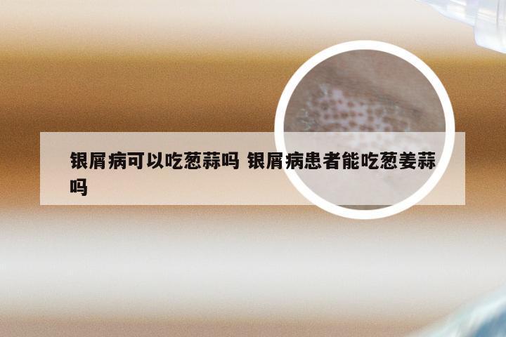 银屑病可以吃葱蒜吗 银屑病患者能吃葱姜蒜吗