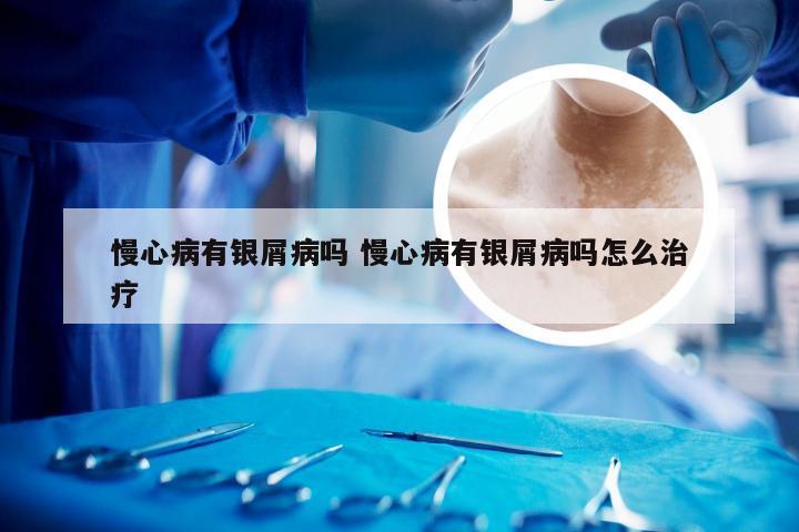 慢心病有银屑病吗 慢心病有银屑病吗怎么治疗