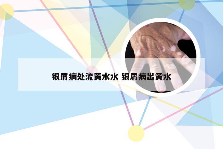 银屑病处流黄水水 银屑病出黄水