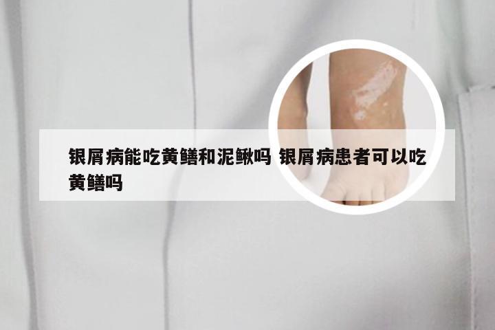 银屑病能吃黄鳝和泥鳅吗 银屑病患者可以吃黄鳝吗