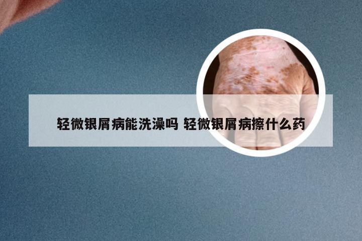 轻微银屑病能洗澡吗 轻微银屑病擦什么药