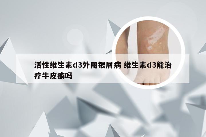活性维生素d3外用银屑病 维生素d3能治疗牛皮癣吗