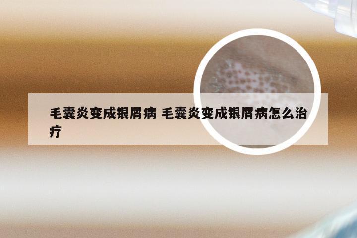 毛囊炎变成银屑病 毛囊炎变成银屑病怎么治疗