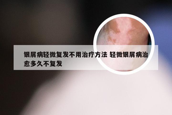 银屑病轻微复发不用治疗方法 轻微银屑病治愈多久不复发