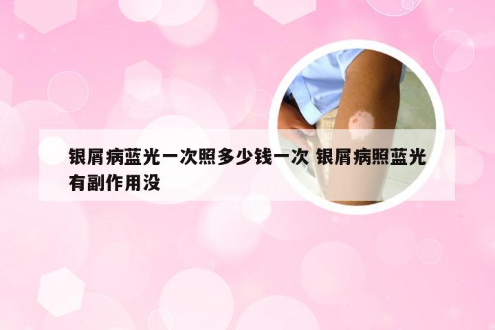 银屑病蓝光一次照多少钱一次 银屑病照蓝光有副作用没