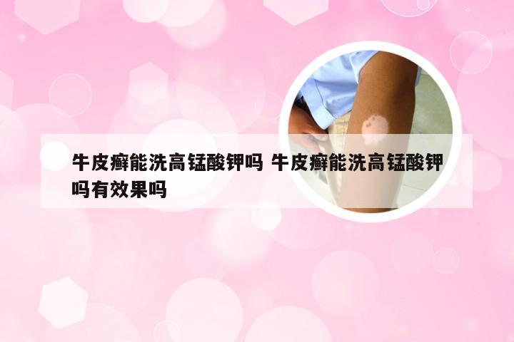 牛皮癣能洗高锰酸钾吗 牛皮癣能洗高锰酸钾吗有效果吗