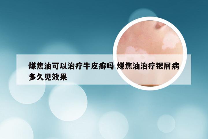 煤焦油可以治疗牛皮癣吗 煤焦油治疗银屑病多久见效果