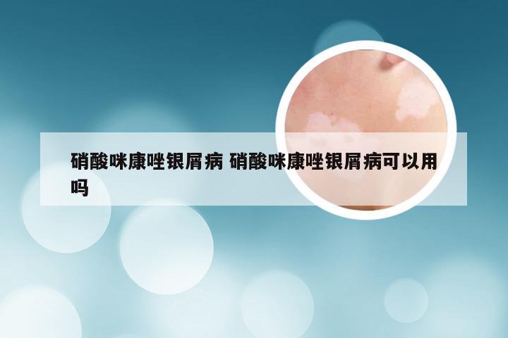 硝酸咪康唑银屑病 硝酸咪康唑银屑病可以用吗