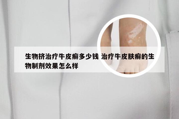 生物挤治疗牛皮癣多少钱 治疗牛皮肤癣的生物制剂效果怎么样