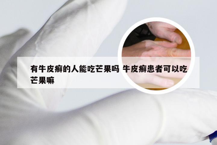 有牛皮癣的人能吃芒果吗 牛皮癣患者可以吃芒果嘛