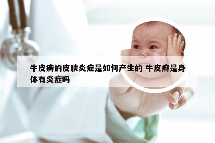 牛皮癣的皮肤炎症是如何产生的 牛皮癣是身体有炎症吗